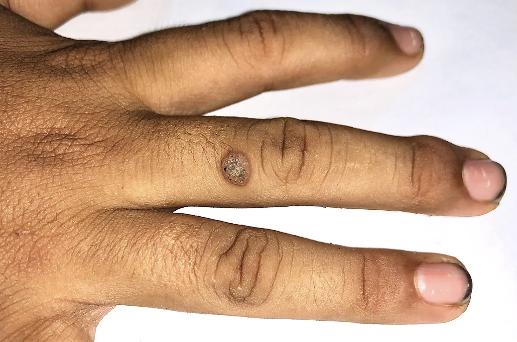 wart